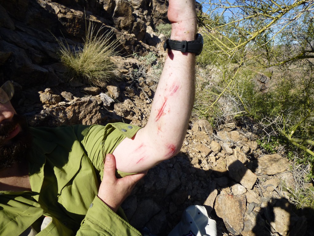 Paul's lacerated arm - his back was much worse